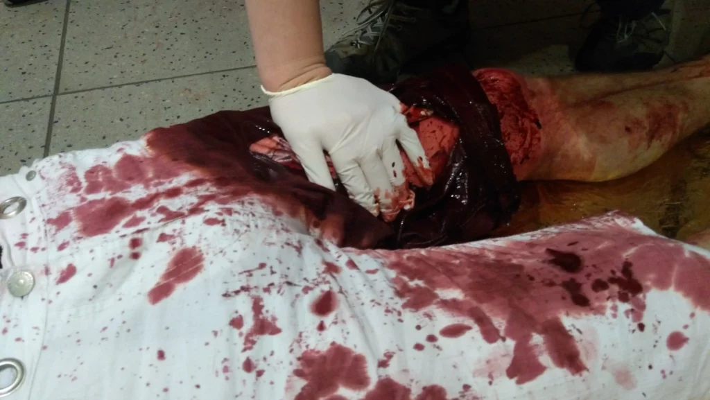 Zástava masivního krvácení přímým tlakem.