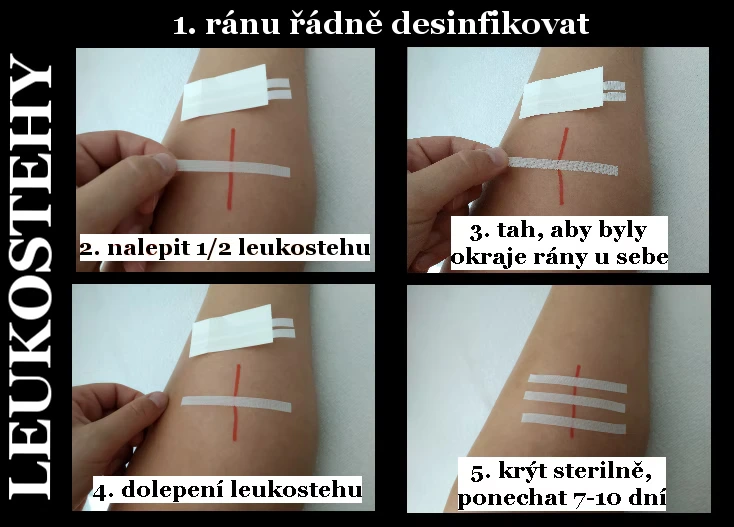 Použití leukostehů.