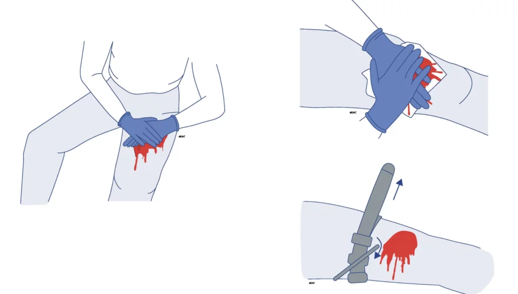 První pomoc při život ohrožujícím krvácení.